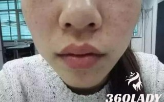 女性长斑的原因有哪些？四个方法教你如何祛斑