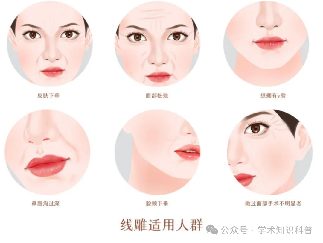 电波拉皮和除皱针哪个效果好_电波拉皮除皱价格_电波拉皮除皱会不会有副作用