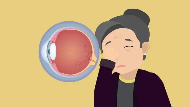 飞蚊症如何缓解_如何缓解飞蚊症加重_飞蚊症怎么可以缓解