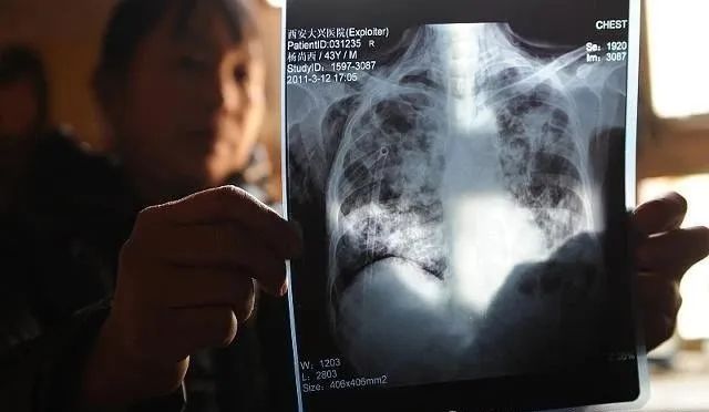 矽肺病药物_矽肺病用药情况_矽肺病的药