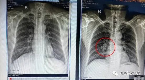 矽肺病药物_矽肺病的药_矽肺病用药情况